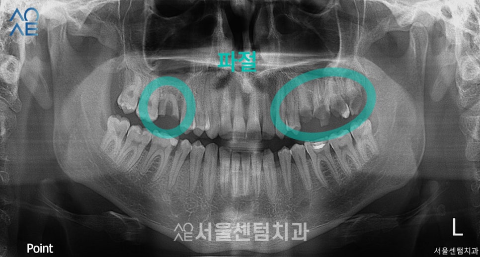 20대임플란트후기 진행과정부터 상세히 관련 이미지 1