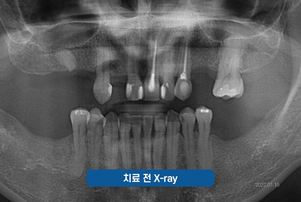 잠원역치과 임플란트 보험 실비 가능하나요? 관련 이미지 10