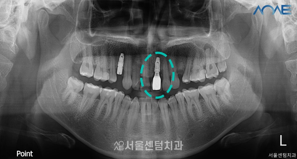 당일임플란트 상담부터 풀과정 공개 관련 이미지 8