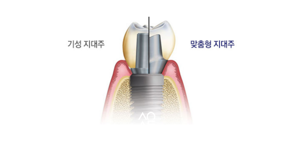 국민 건강보험 임플란트 노인 무치악의 기준은? 관련 이미지 10