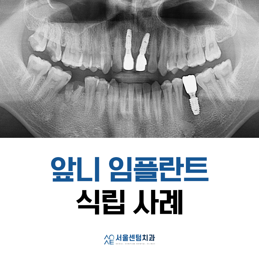 앞니 임플란트 식립으로 저작 기능을 끌어올린 증례 관련 이미지 1
