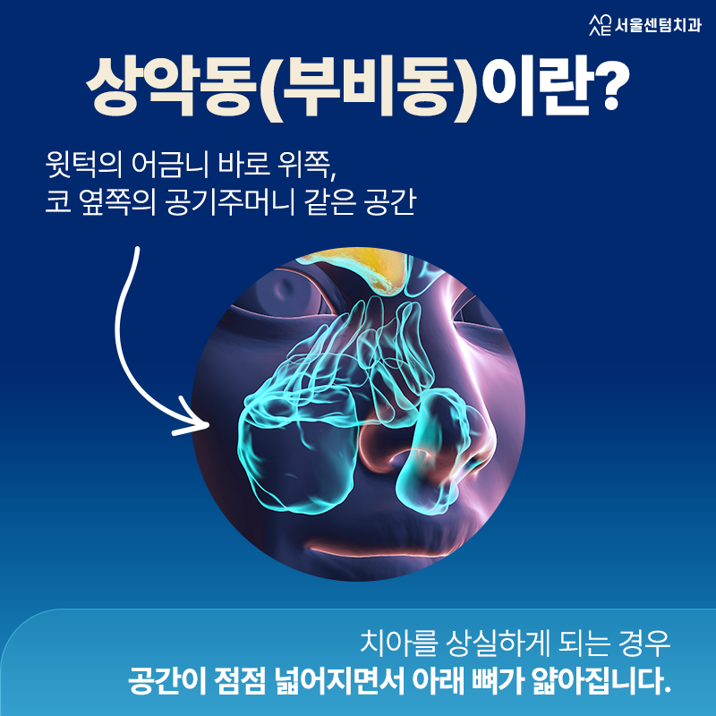 Pain After a Sinus Lift: Why Is It Suddenly Necessary When You Went to the Dentist for Implants? image 2