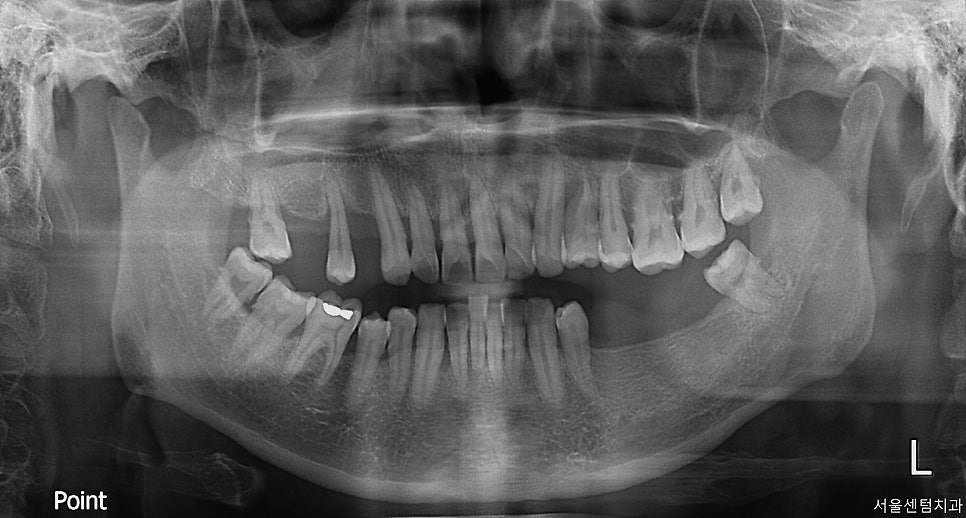 임플란트 순서 어금니부터 앞니부터 어디부터 해야할까요 관련 이미지 3