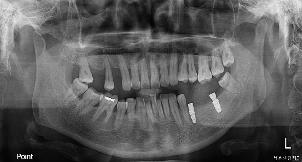 임플란트 순서 어금니부터 앞니부터 어디부터 해야할까요 관련 이미지 4