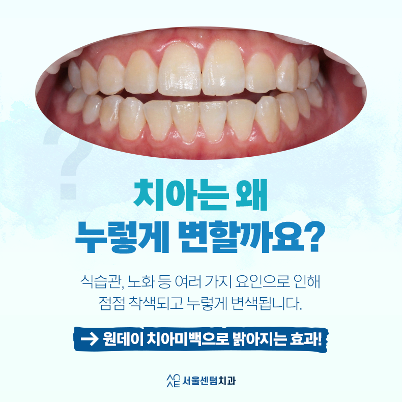 강남 치아미백 시간, 효과, 방법 한눈에 확인 관련 이미지 3