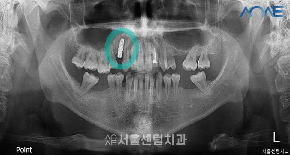 Here’s How a Korean-Made Implant Is Actually Placed image 5