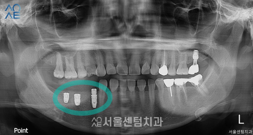 40대임플란트 수술 어떻게 하나요? 관련 이미지 2