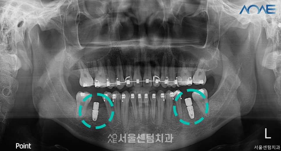 교정임플란트 모두 맡겨주신 결과 관련 이미지 4