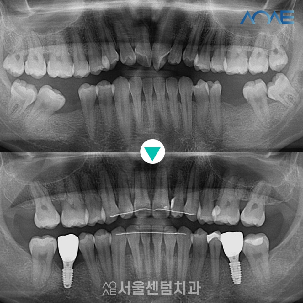 교정임플란트 모두 맡겨주신 결과 관련 이미지 6