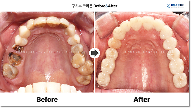 충치신경치료 종류 모조리 알려드릴게요. 관련 이미지 12