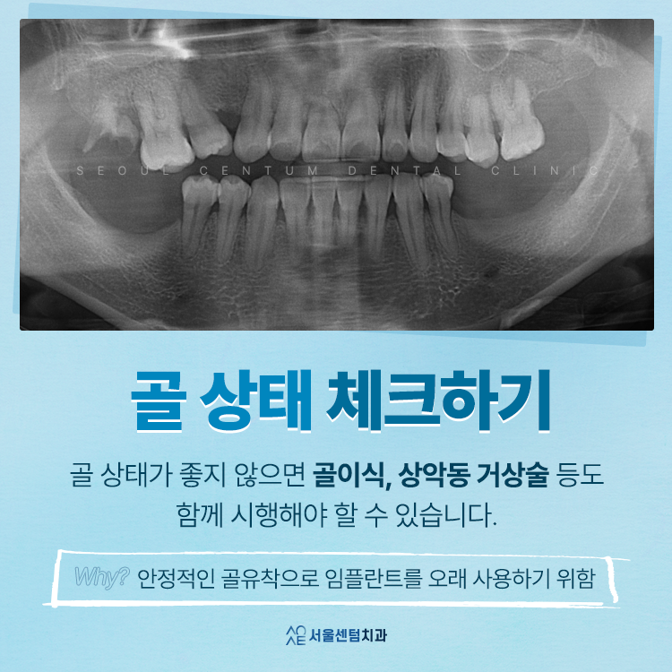 어금니 임플란트 앞니보다 신중해야 한다? 숨은 진실 관련 이미지 4