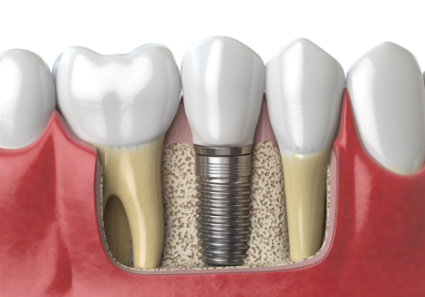 신사동치과 임플란트 끝난 후 절대 잊지 말아야 할 주의사항 관련 이미지 13