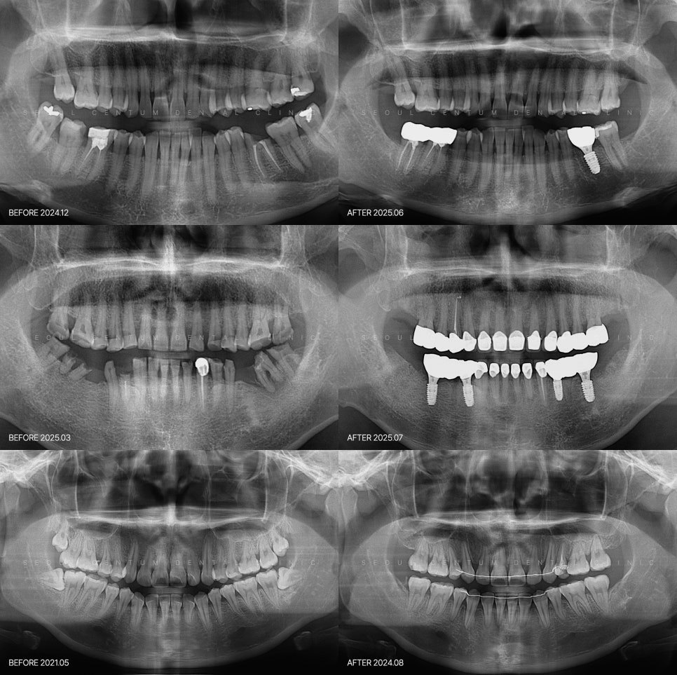 스케일링 후 보니까 치아에 하얀 얼룩인지 치석 같은 게 껴있어요 관련 이미지 6