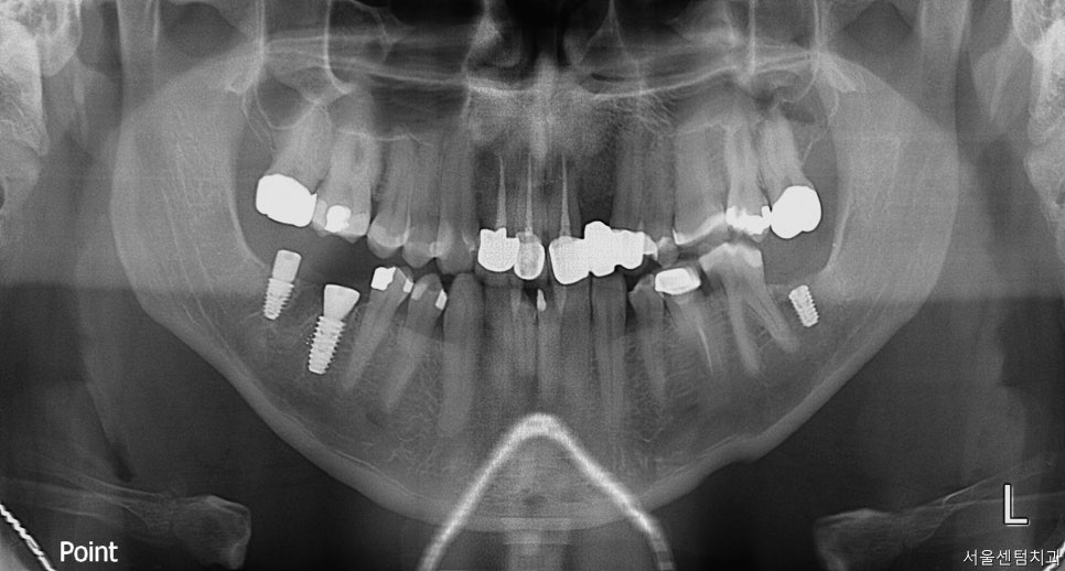 신사역치과 발치후 임플란트 시술과정 30대 남성 케이스 관련 이미지 2