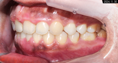 비발치로 돌출입 해소한 증례 관련 이미지 14