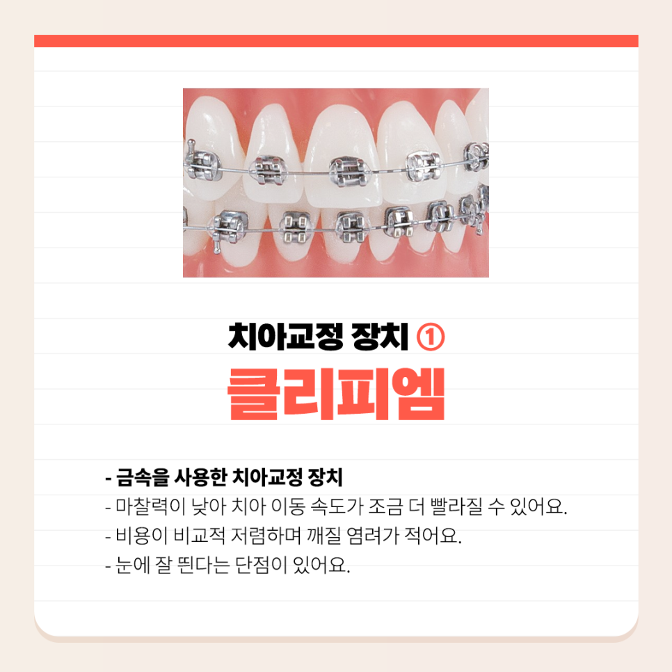 치아교정장치 종류 하나하나 알려드려요 관련 이미지 2