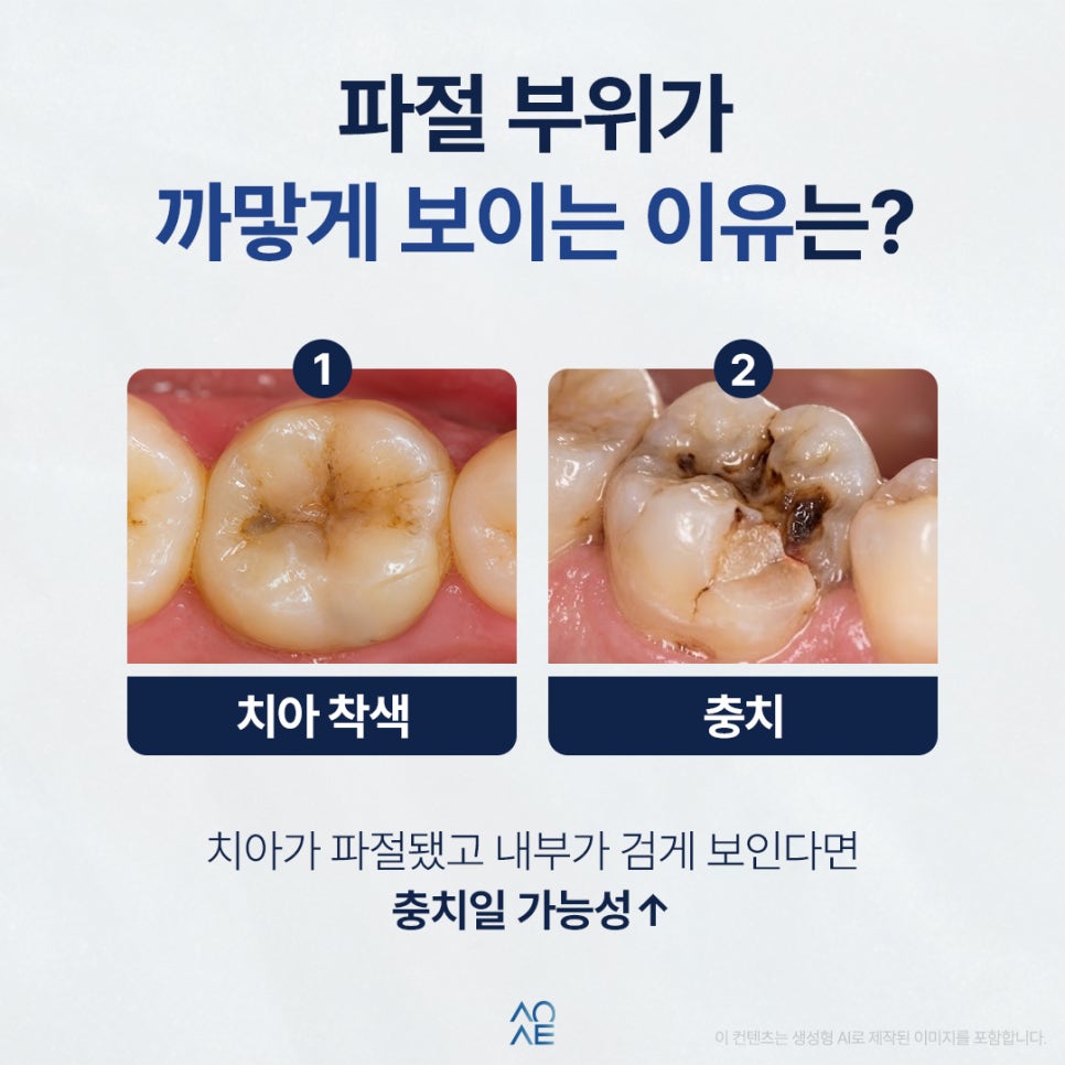 Is tooth chipping caused by cavities? I’m also wondering about the treatment cost. Will it be very expensive? image 2