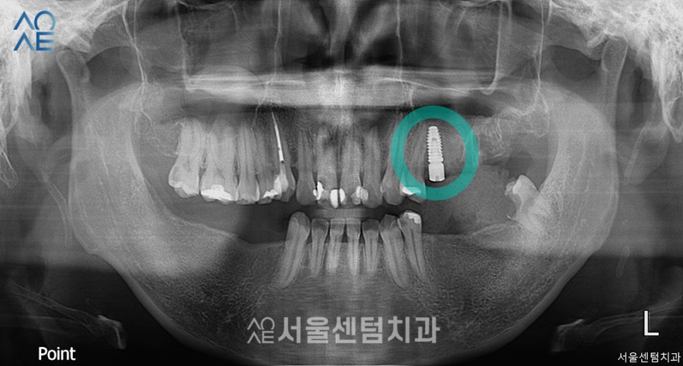 30대임플란트 치아상태 좋지 않아도 안심 관련 이미지 2