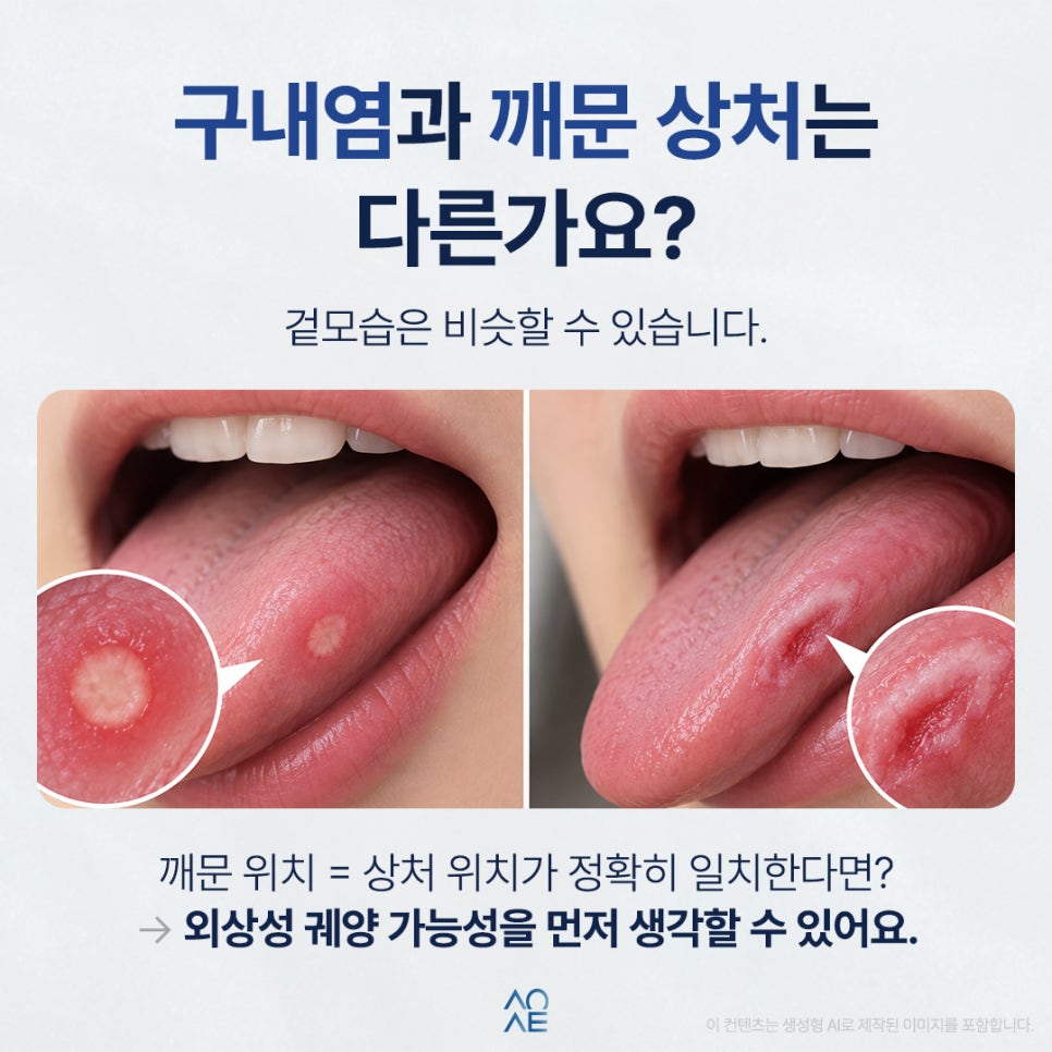 혓바닥 구내염 혀 세게 깨물었다가 생길 수 있는 건가요? 관련 이미지 2