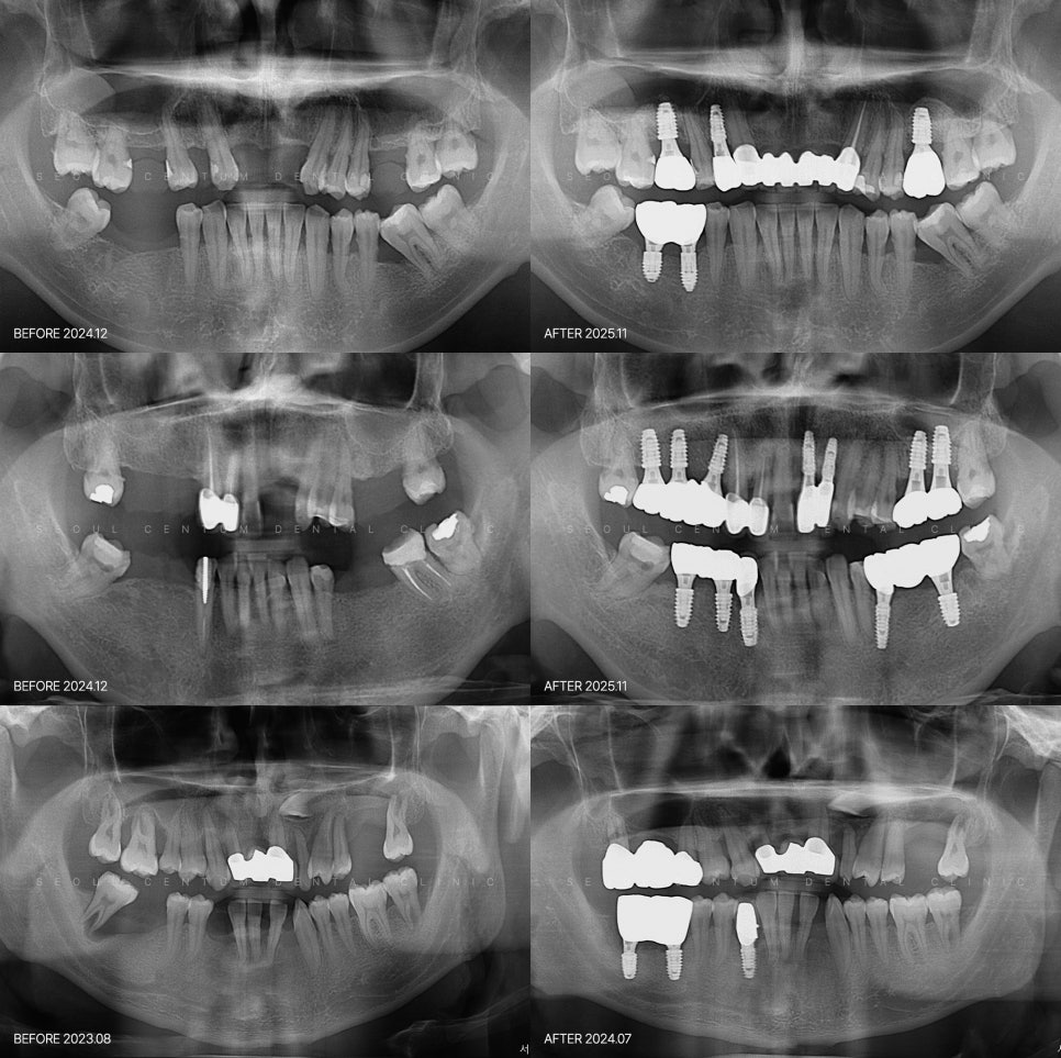 신경치료 시 크라운 수명이 달라지는 원인은 종류 때문일까 관련 이미지 6