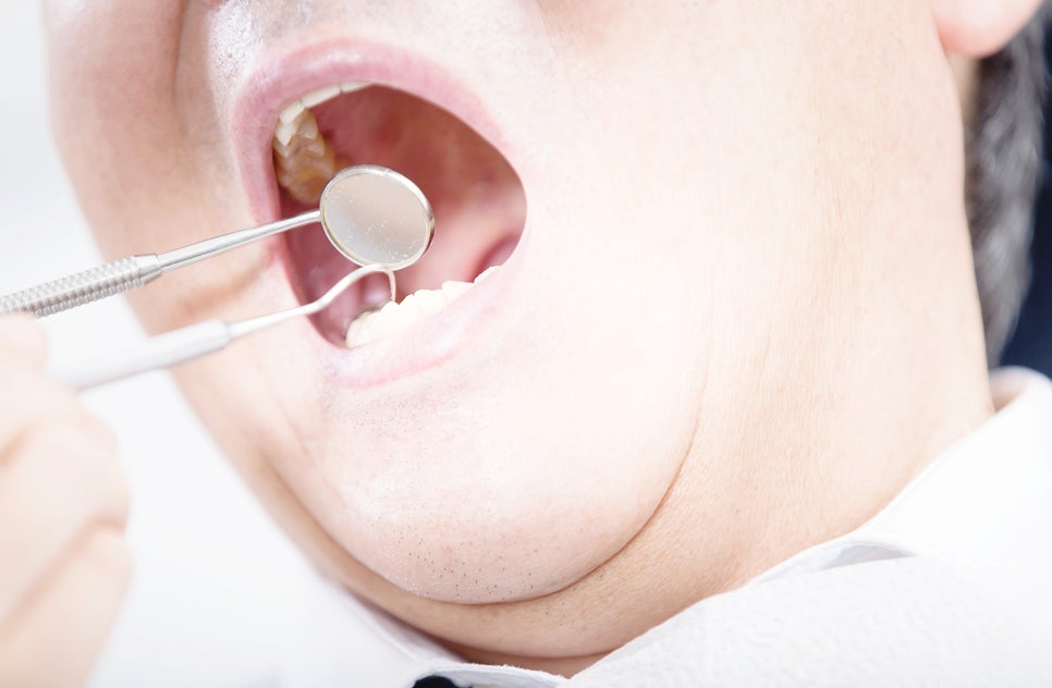 치아 스케일링 후 이시림 통증 완화법은? 관련 이미지 6