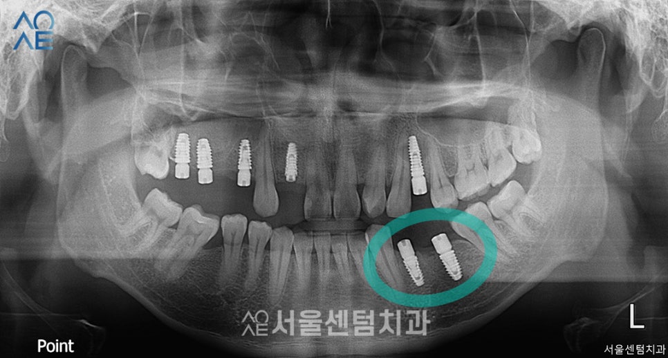 임플란트 과정 기간 실제 사례로 설명드려요 관련 이미지 4