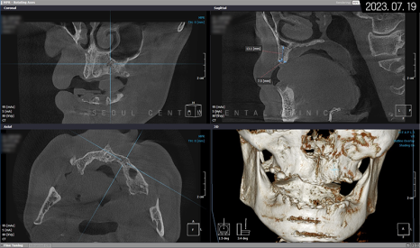 전체임플란트 기간 예상보다 줄어들 수 있는 방법과 증례 공개 관련 이미지 7