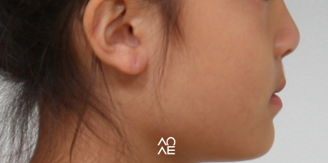 주걱턱 교정, 페이스마스크 활용 주의사항 관련 이미지 5