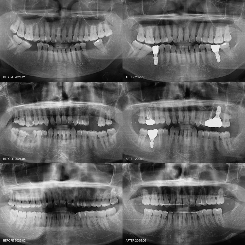 사랑니당일발치 가능한 조건과 준비까지 가이드 잡아드립니다 관련 이미지 6