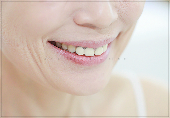 임플란트 뼈이식이 필요한 경우 구체적으로 확인하고 싶다면 관련 이미지 9