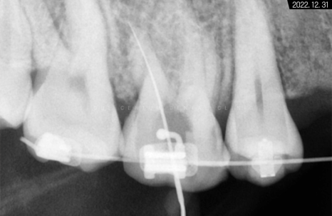 돌출입 및 신경치료와 임플란트 식립 동시 진행 증례 관련 이미지 8