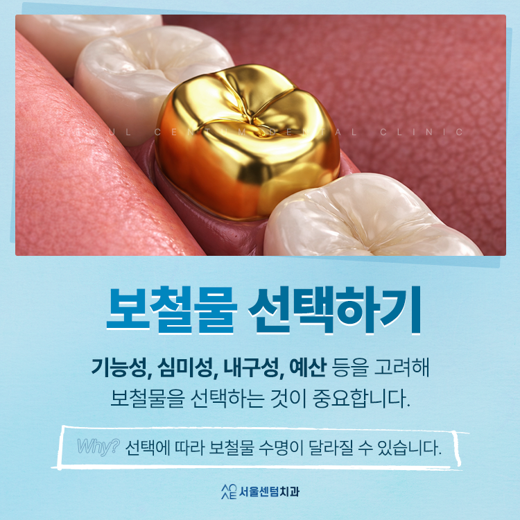 어금니 임플란트 앞니보다 신중해야 한다? 숨은 진실 관련 이미지 5
