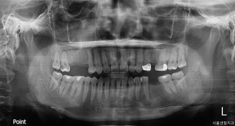 40대 임플란트 치료 케이스 상악동거상술 골이식까지 관련 이미지 15