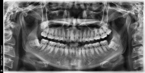 신사역 매복 사랑니 4개 발치 꼭 해야하나요? 관련 이미지 7