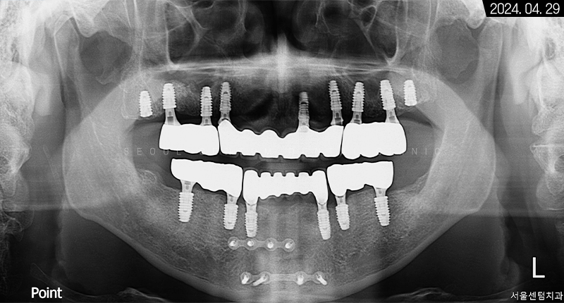전체임플란트 기간 예상보다 줄어들 수 있는 방법과 증례 공개 관련 이미지 15
