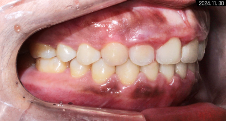 비발치로 돌출입 해소한 증례 관련 이미지 13