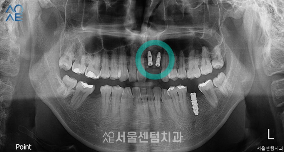 앞니 임플란트 후기 실제사례 보여드려요 관련 이미지 3
