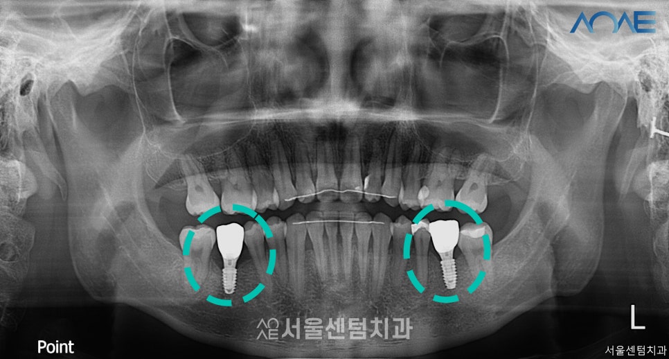 교정임플란트 모두 맡겨주신 결과 관련 이미지 5