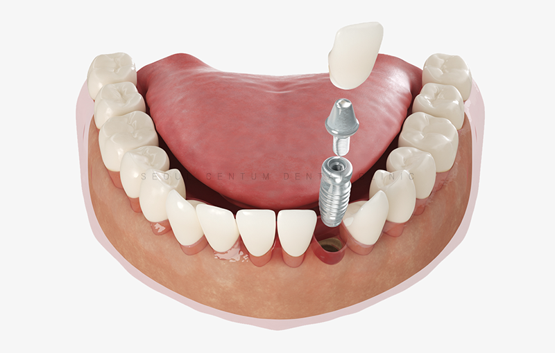 임플란트잘하는곳 해당되면 이러한 이유 때문일지도 모릅니다. 관련 이미지 6
