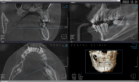 돌출입 및 신경치료와 임플란트 식립 동시 진행 증례 관련 이미지 19