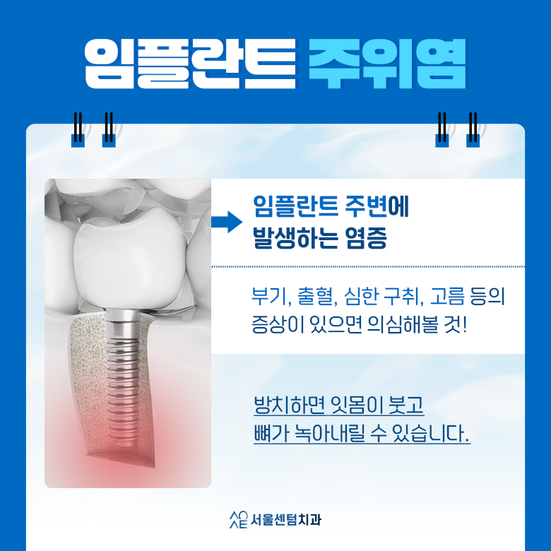 임플란트 수명 늘리려면 꼭 읽어보세요 관련 이미지 5