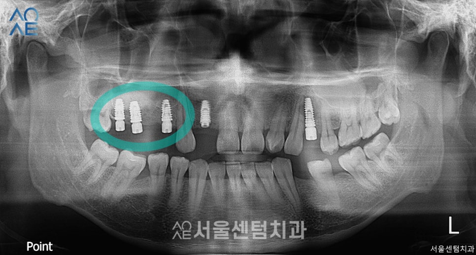 임플란트 과정 기간 실제 사례로 설명드려요 관련 이미지 3