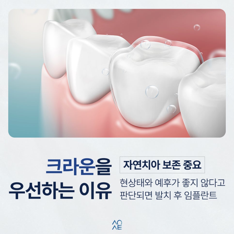 Crown or Implant—which Should I Choose? Guidelines for Deep Cavities image 4