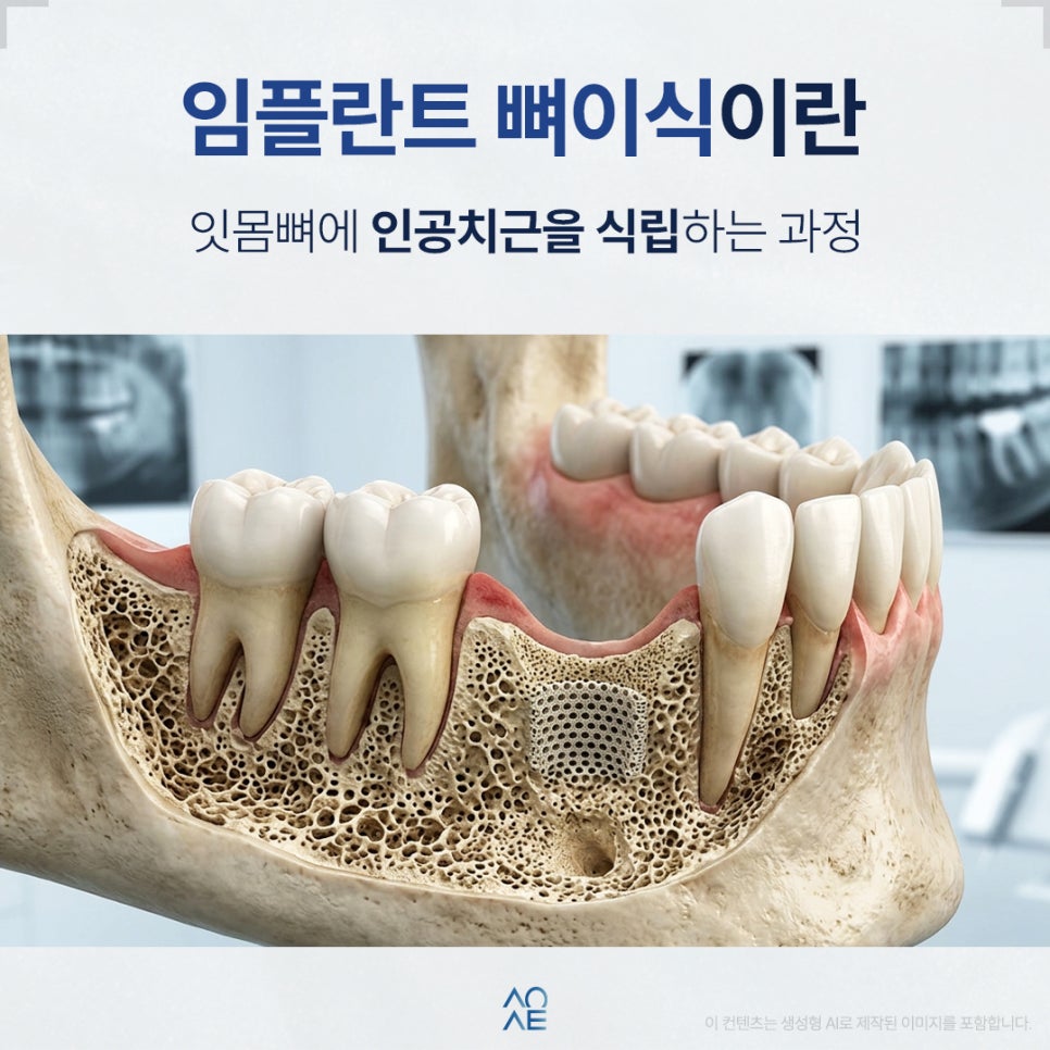 임플란트 뼈이식 꼭 해야할까요? 필요한 경우 관리 방법 정리본 관련 이미지 2