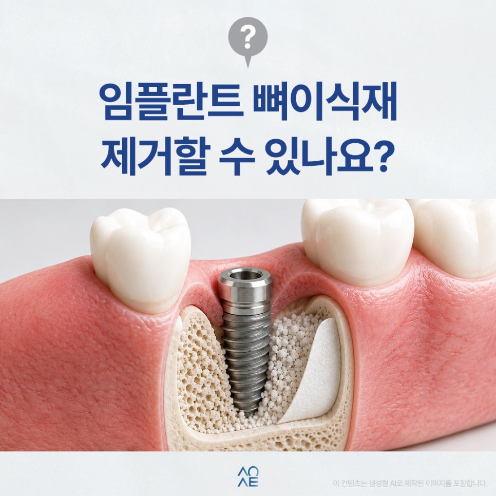 임플란트 뼈이식 재료 완전히 제거하고 싶은데 가능한가요? 관련 이미지 1