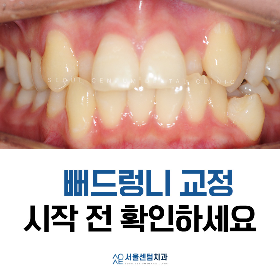 Read This Before Starting Protruding Teeth Correction image 1