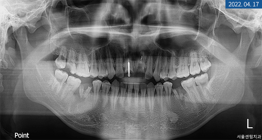 앞니 임플란트 식립으로 저작 기능을 끌어올린 증례 관련 이미지 3