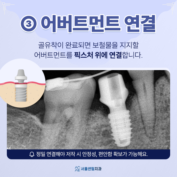 임플란트 할 때의 절차 과정은 대체로 이렇게 진행돼요 관련 이미지 4