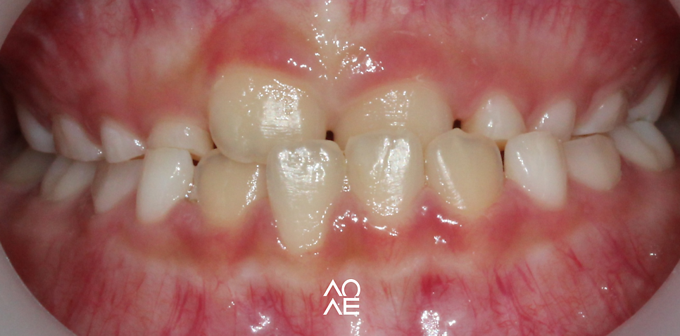 주걱턱 교정, 페이스마스크 활용 주의사항 관련 이미지 3