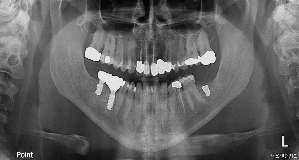 신사역치과 발치후 임플란트 시술과정 30대 남성 케이스 관련 이미지 7